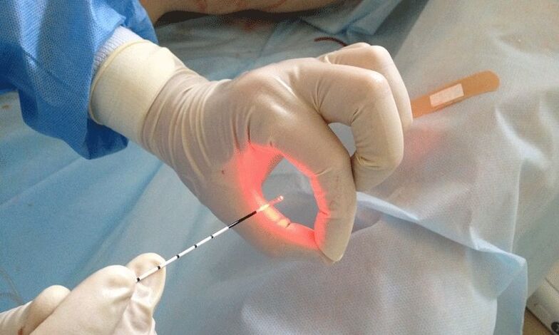tratamiento con láser para la prostatitis