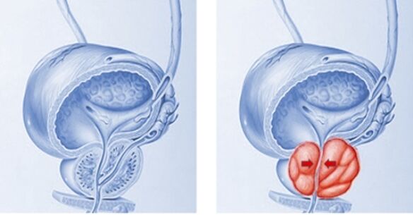 próstata sana e inflamada con prostatitis